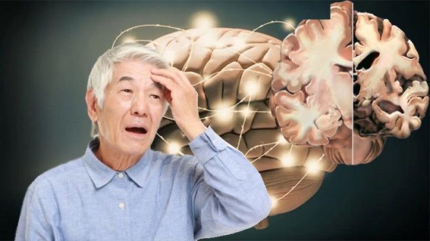 Top bài thuốc hỗ trợ trị bệnh Alzheimer hiệu quả