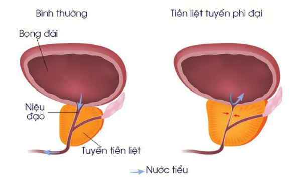 Top bài thuốc trị phì đại tuyến tiền liệt hiệu quả