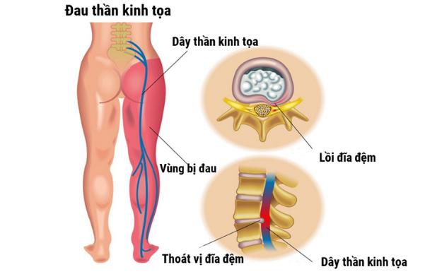 4 bài thuốc trị đau thần kinh tọa