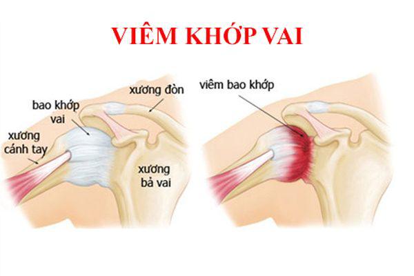 Các phương pháp hỗ trợ điều trị viêm quanh khớp vai