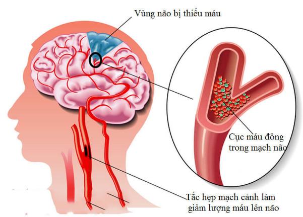 Đông y điều trị thiểu năng tuần hoàn não