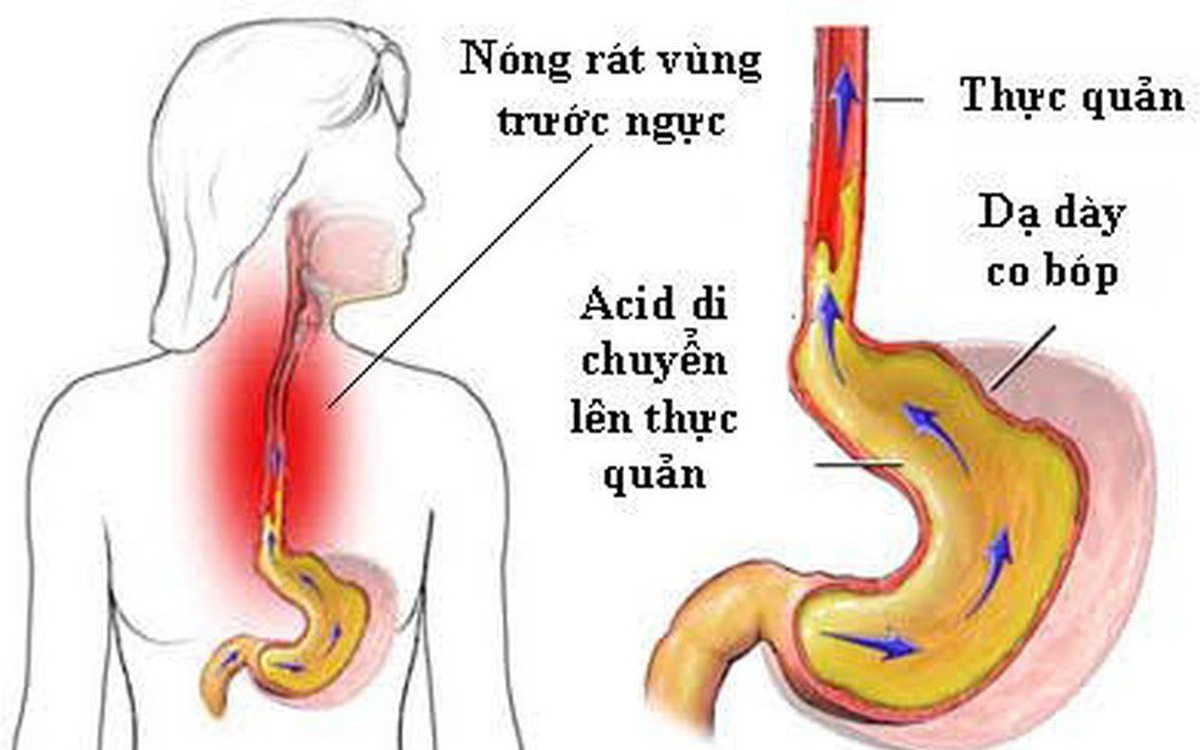 Các giải pháp giảm triệu chứng trào ngược dạ dày thực quản