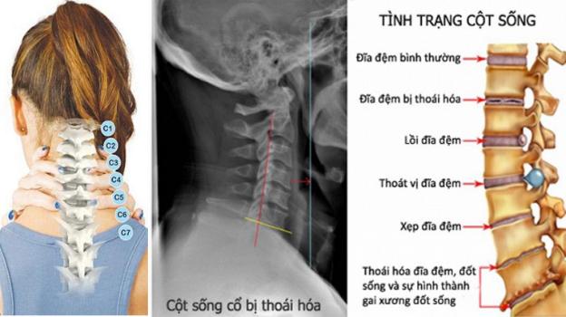 4 bài thuốc chữa bệnh ở cột sống cổ