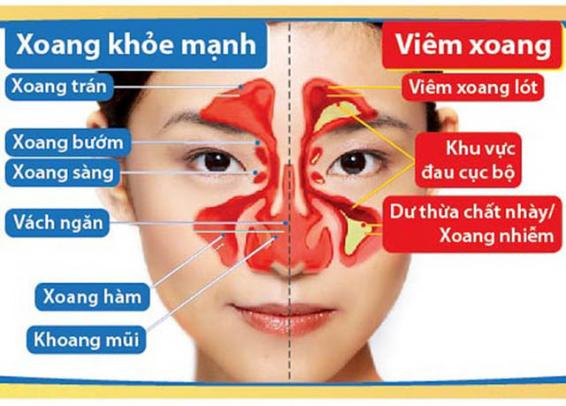 Bài thuốc hỗ trợ điều trị viêm xoang